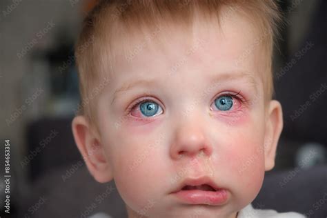 Red swollen eyes from conjunctivitis child, ill allergic eyes in babies ...