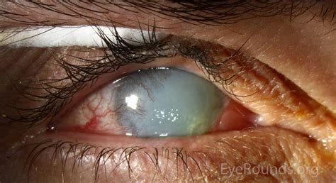 Painful Red Eye | Causes | Ophthalmology | Geeky Medics