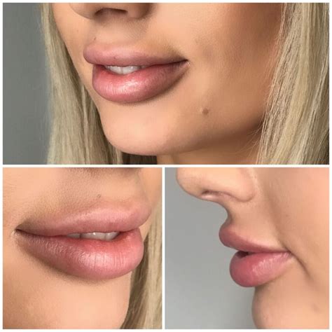 Lip Injection Shapes for Your Face: Which Filler Techniques?