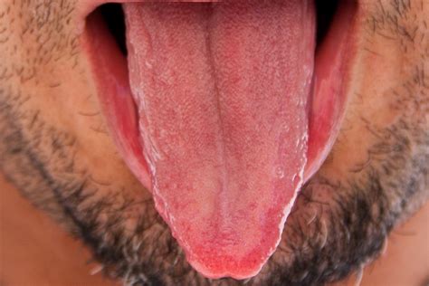 Swollen Taste Buds Causes, Getting Rid of Tip, Back Tongue Enlarged ...