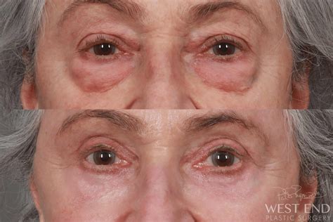 Lower & Upper Blepharoplasty (3 Months Post-op) Case 10337 - West End Plastic Surgery