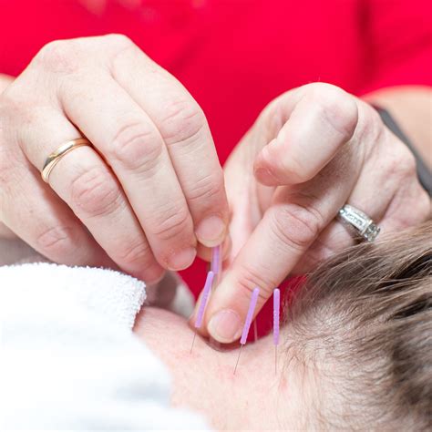 Physical Therapy And Needling at Debra Baughman blog