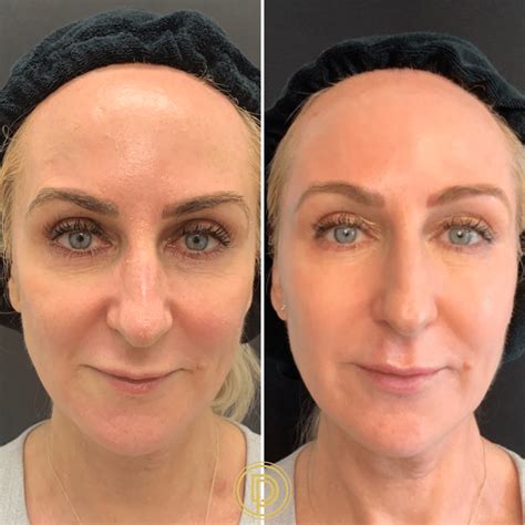 Is Sculptra a Liquid Facelift? How Long Does It Last? | Dallas Dermatology