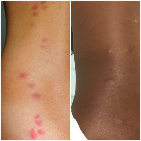 Bed Bugs Rash On Black People How To Treat Bed Bug Bites Bed Bug