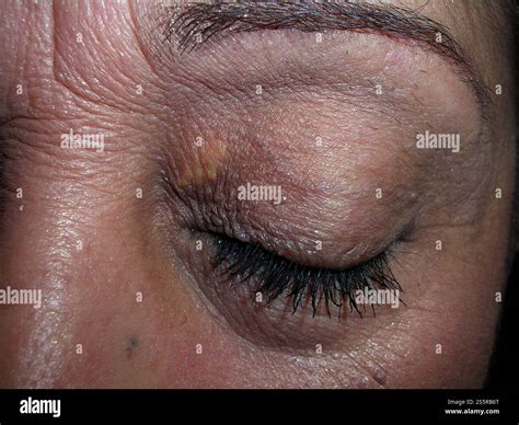 Xanthelasma deposits around a the eye of a Hispanic woman. This is a collection of cholesterol ...