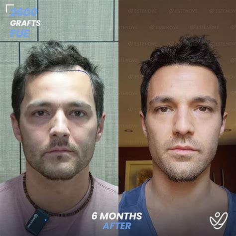 Hair Plugs vs. Hair Transplant in 2026: See the Difference