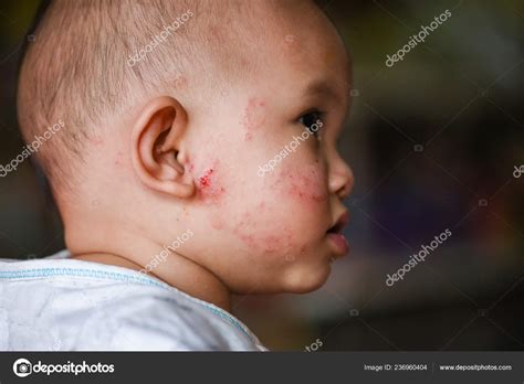 Baby Dry Skin Rash