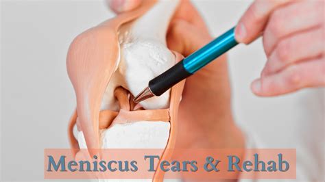 Meniscus Tears & Rehab | PhysioChoice