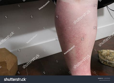 Sun Poisoning On Legs