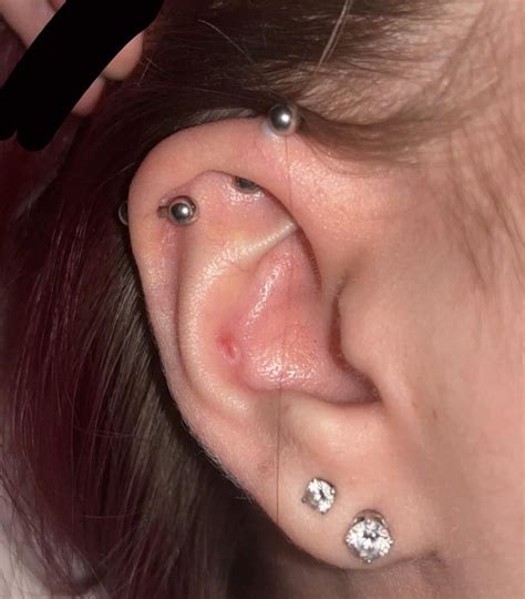 Keloid or irritation bump? : r/PiercingAdvice