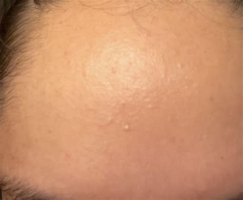 Why do I always have all these little bumps on my forehead? : r/30PlusSkinCare