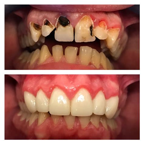 Front Tooth Root Canal