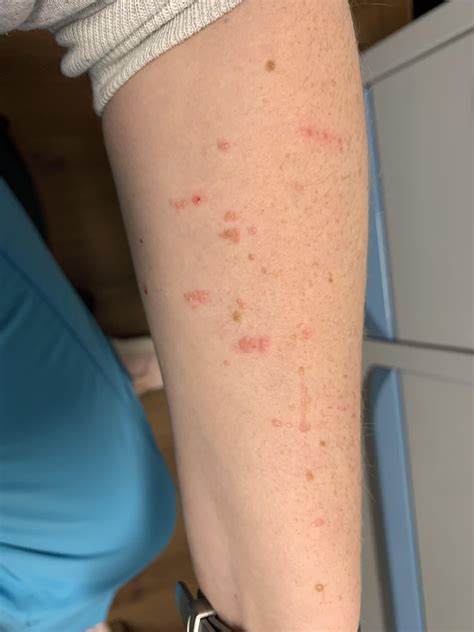 Dry, red, itchy bumps appeared in healed scars : r/DermatologyQuestions