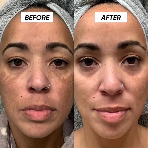 Glycolic Acid After Tretinoin at Odessa Francis blog