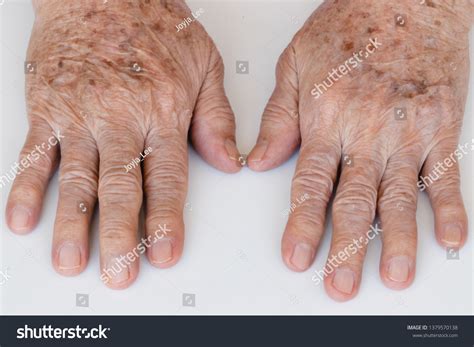 Closeup Age Spots Skin Liver Spots Stock Photo 1379570138 | Shutterstock