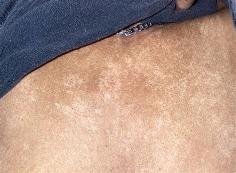 24F. I was born with my skin like this (chest area) and never found out what was going on. Is it ...