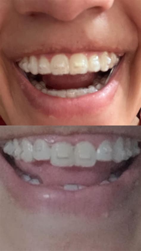 Realized I once had a bunny teeth : r/Invisalign