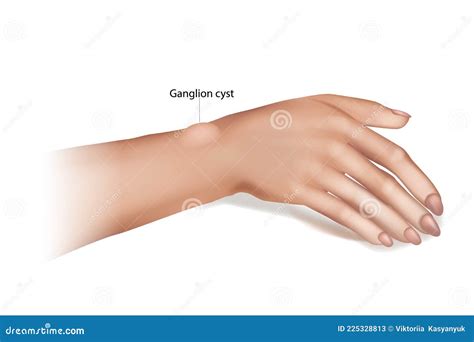 Ganglion Cyst of the Wrist and Hand. Synovial Cyst or a Gideon`s Disease, or a Bible Cyst, or a ...
