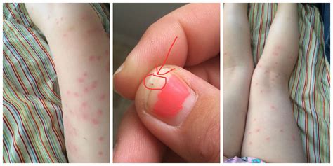 Seed Ticks Bites On Humans