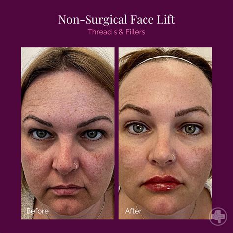 Non-surgical Face Lift – Conquer 180