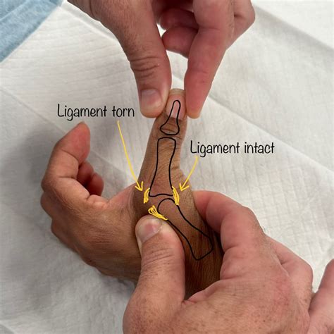 Thumb Ulnar Collateral Ligament (UCL) Repair | Dr Oscar Brumby-Rendell ...