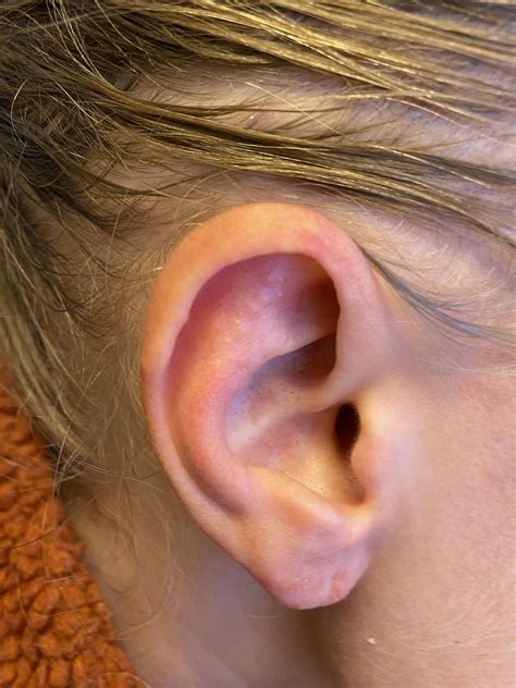 Bumpy ear rash??? : r/DermatologyQuestions