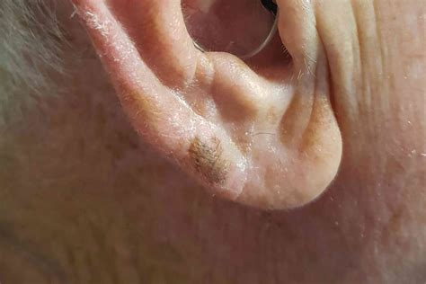 Crusty Stuff Behind Ears