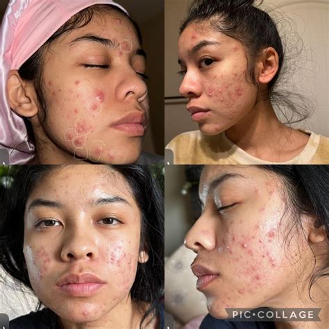 Doxiciclina Acne Antes E Depois - RETOEDU