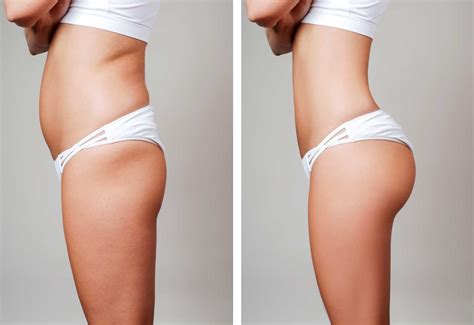 Sculptra Butt Lift - Fantazia | Aesthetics | Botox | Dermal Filler | Richmond Hill