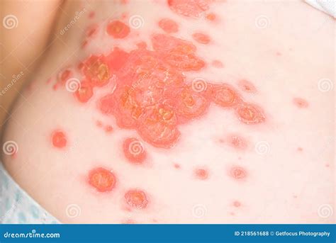 Dermatitis with Mild Pink or Red Skin Rash in an Infant Stock Photo - Image of medical, care ...