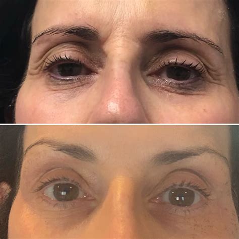 Get rid of forehead wrinkles with plasma pen fibroblasting – Artofit