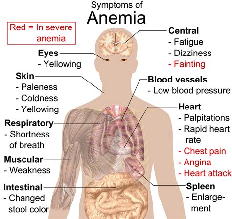 Sickle Cell Symptom #1- Anemia - 10003 WARRIOR PROJECT