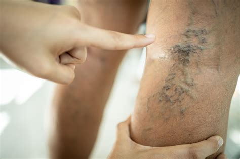 What Are the Stages of Varicose Veins? A Complete Guide to Vein Disease ...