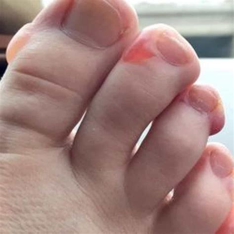 Red Blisters On Toes