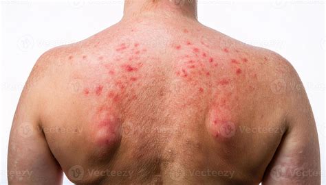 close-up of severe heat rash on the back with inflamed red bumps and ...