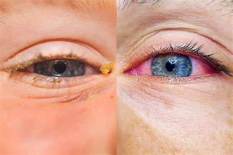 Viral vs. bacterial pink eye