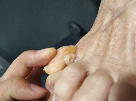 Corn On Side Of Foot Online | emergencydentistry.com