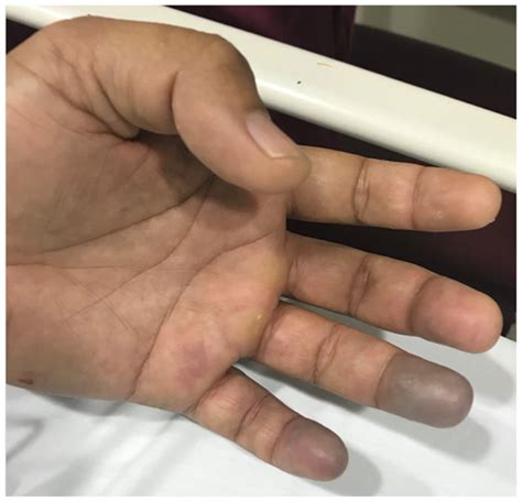 Hypothenar Hammer Syndrome