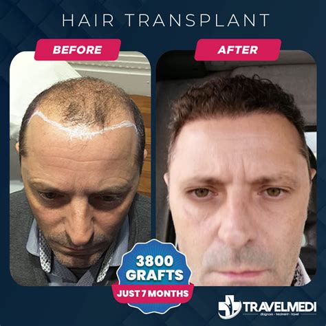 Why Is Turkey So Famous For Hair Transplant at Indiana Seery blog