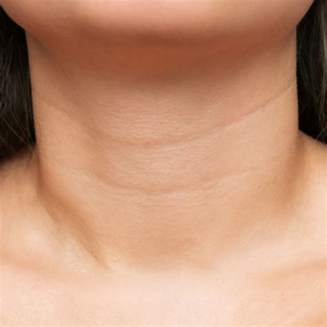 Understanding Neck Wrinkles: Causes & Treatment Options