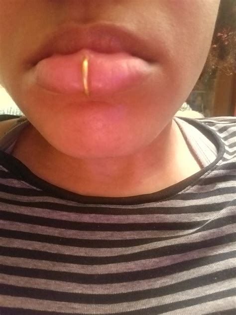 Vertical Labret Piercing Scar