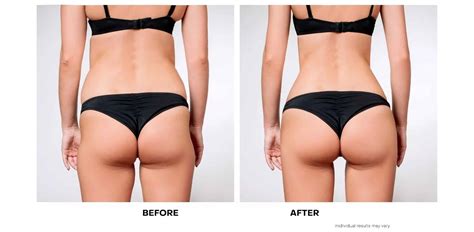 Sculptra Burlington | Best Non-Surgical Butt Lift Injections Burlington Near Me