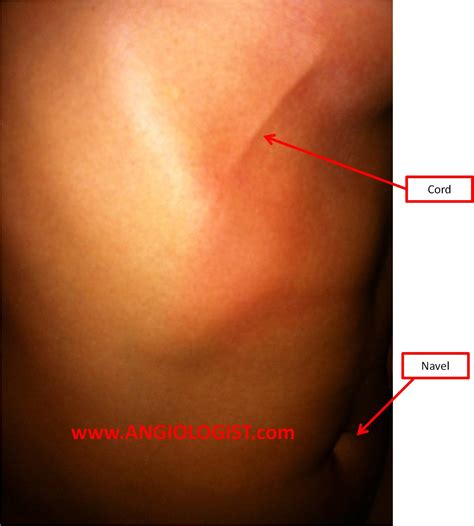 Mondors Disease Penile Mondor's Disease: Symptoms, Causes, And