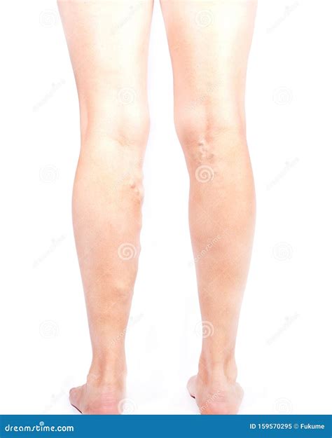 Painful Varicose Spider Veins and on a Woman Legs, Vascular Diseases, Phlebeurysm Problems with ...