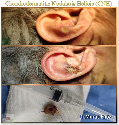 Chronic Inflammatory Lesion in the Auricle: Chondrodermatitis Nodularis ...