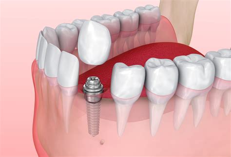 Dental Implant Crown