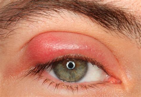What Causes Eyelid Inflammation? (with pictures)