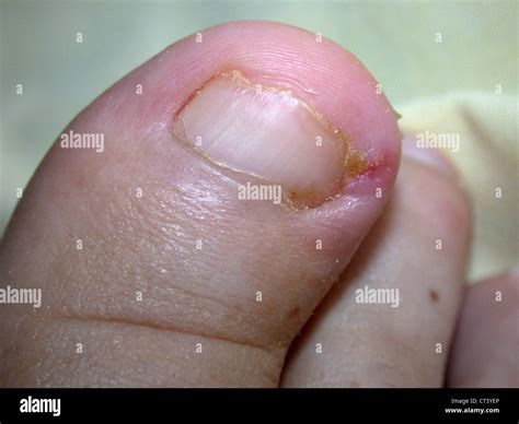 Ingrown Fingernail Cuticle