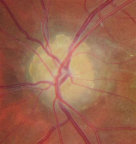 Optic Disc Drusen