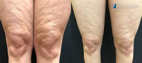 Laser Liposuction Thighs at John Triche blog